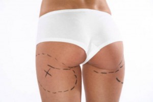 Sollevamento glutei