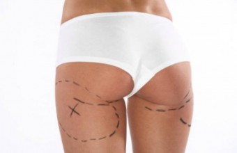 Sollevamento glutei