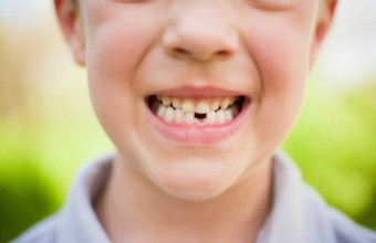 Affollamento dentale bambini