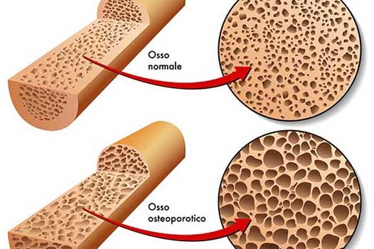 Osteoporosi