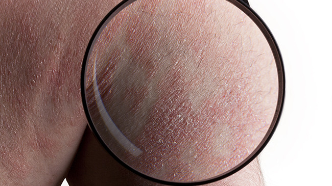 Psoriasi: malattia discriminante per 8 persone su 10