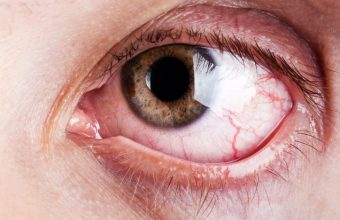 Sindrome dell'occhio secco