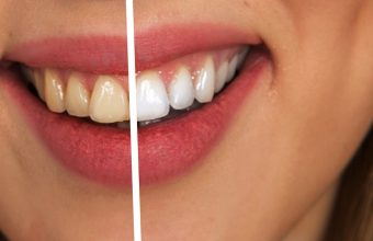 Macchie sui denti