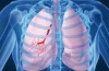 Sindrome di scimitarra: difetto congenito nel ritorno venoso del polmone destro