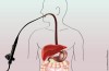 Gastrite duodenale: la rileva la gastroscopia