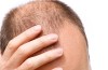 Calvizie: problema risolto con la rigenerazione cellulare non chirurgica