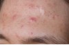 Contro l’acne: cibi integrali, proteine vegetali, olio extravergine d’oliva