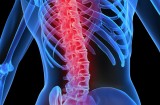 Spondilite: infezione della colonna vertebrale