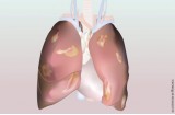 Adenocarcinoma polmonare