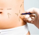 La chirurgia addominoplastica: via il grasso, via la pelle in eccesso