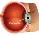 Cataratta: processo di perdita della trasparenza del cristallino dell'occhio
