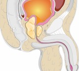 Stenosi uretrale: restringimento del canale uretrale
