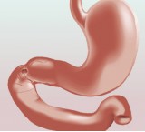 Ulcera duodenale: lesione causata da acido che colpisce la mucosa del duodeno