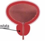 Ipertrofia prostatica: ingrossamento della prostata